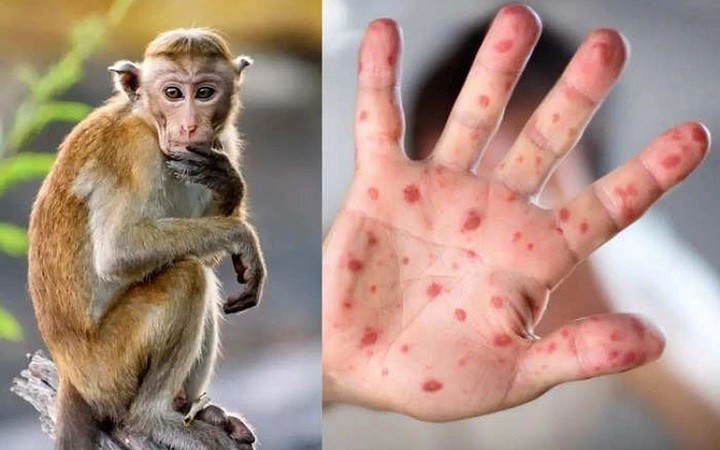 Bộ Y tế xếp đậu mùa khỉ vào nhóm bệnh truyền nhiễm nguy hiểm