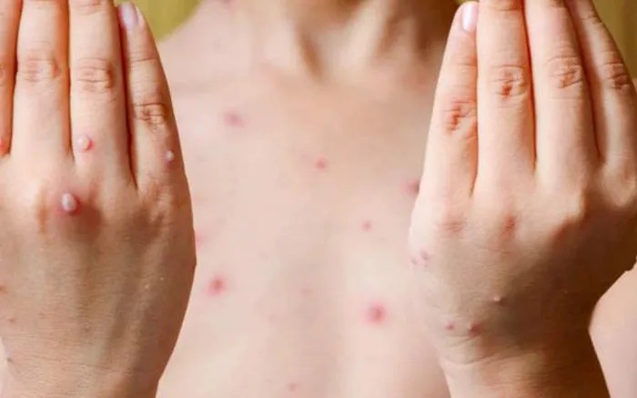 Các biến chứng thủy đậu nguy hiểm, có thể gây tử vong
